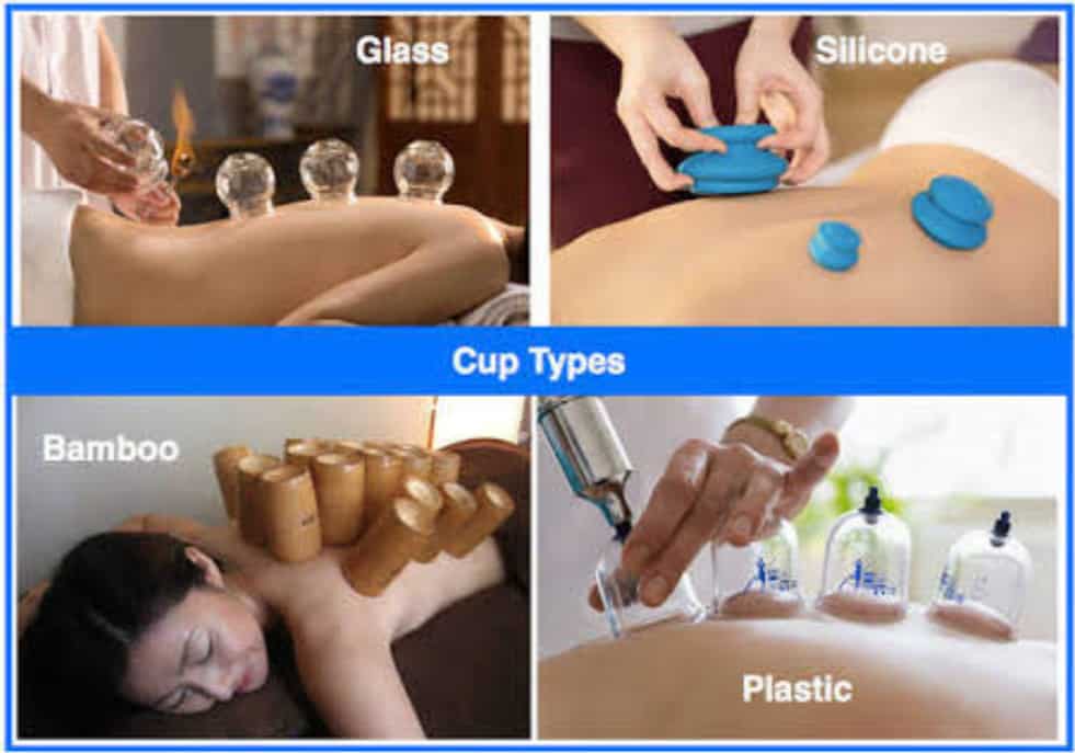Cupping therapy treatment at Acutouch Wellness